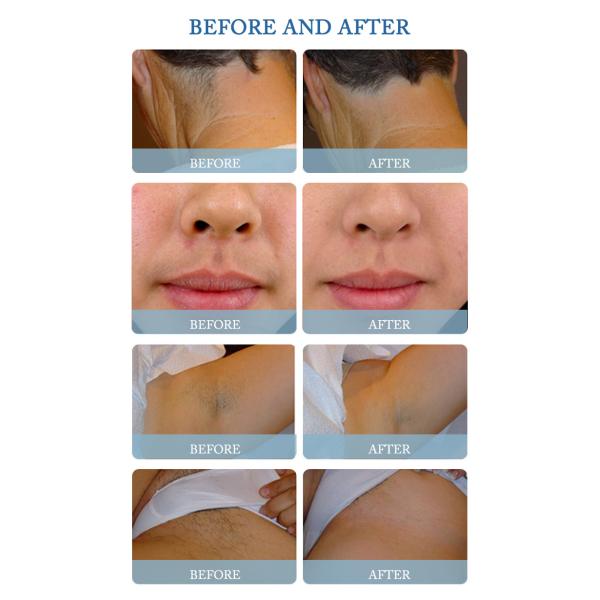 808nm Diode Laser Permanent Hair Removal Machine 1200W For Skin Rejuvenation