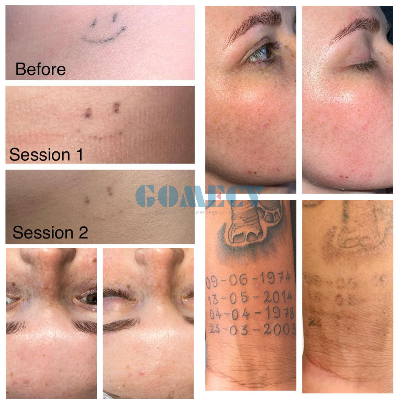 Professional Q Switched Nd YAG Laser Machine Multi Wavelength 532nm 755nm 1064nm