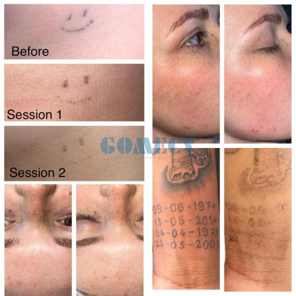 Professional Q Switched Nd YAG Laser Machine Multi Wavelength 532nm 755nm 1064nm 1320nm for Tattoo and Pigment Removal