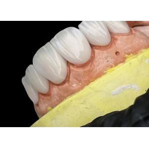 Porcelain Emax Veneer Translucency Bonding For Precise Esthetic Restorations
