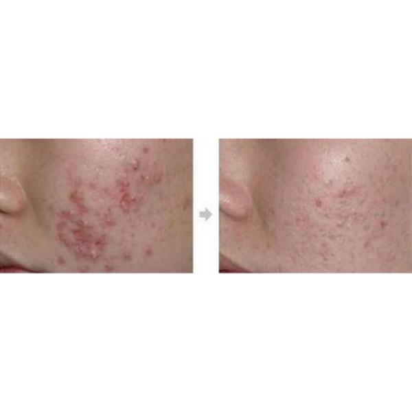 Ultrasound skin scrubber Serum and water peeling hydro skin facial with Hydradermabrasion