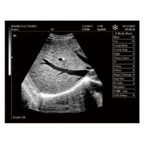 Mobile Ultrasound Machine Digital Laptop Ultrasound Scanner with 100 Frames