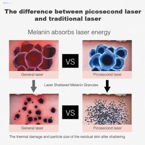 Portable Picosecond Laser Machine High Efficiency For Tattoo Removal