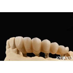 Experience Ultimate Esthetics With Aesthetically Pleasing Dental Implant Crown