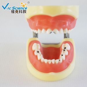 Advance PVC Plastic Child Caries Teeth Model Dental Life Size Eco - Friendly