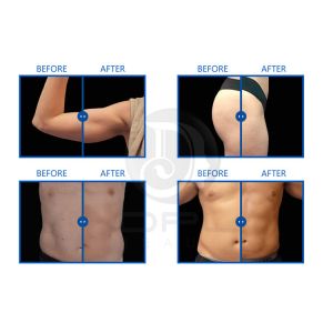 RF EMS Sculpting Machine EMS Muscle Stimulator Pro Max With 4 Handles