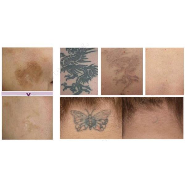 2000W Picosecond ND YAG Laser Tattoo Removal Machine 755nm Q - Switched