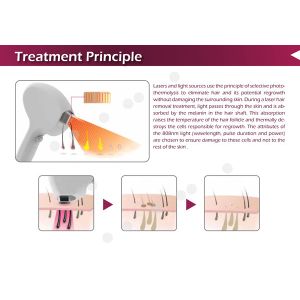 2017 High quality newest non-invasive 10.4 inch screen ingrown hair removal for