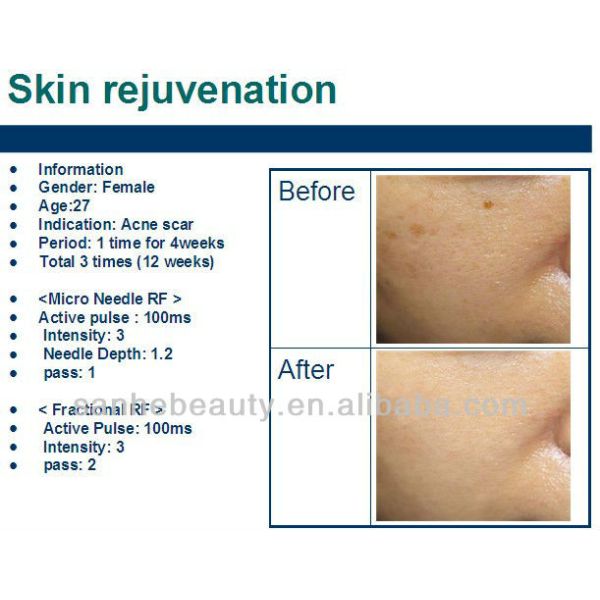 skin lifting machine fractional micro needles RF
