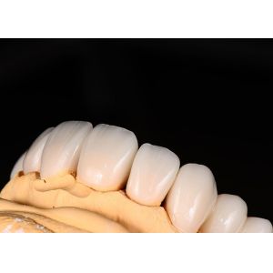 Advanced Translucency Ceramic Crowns and Bridges Enhance Your Smile with