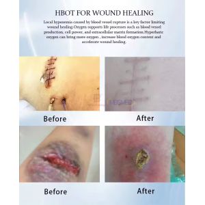 HBOT 1.5 ATA 2 ATA 3 ATA HBOT Chambers Dual Single Person Hard Shell Oxygen