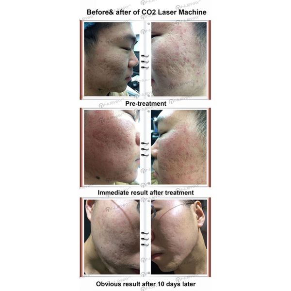 Top quality RF tube Fractional CO2 laser skin rebirth Vaginal tightening laser device