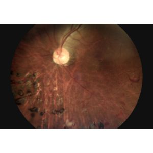 3.5" Ophthalmology Diagnostic Equipment For Glaucoma Diabetes