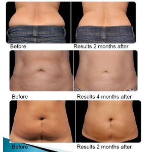 Reduce Body Sincoheren Vacuum Cavitation Slimming Machine