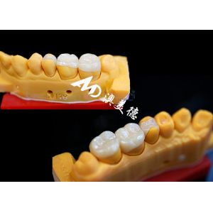 OEM Precision Fit Ceramic Inlays Onlays for Durable and Natural-Looking Dental