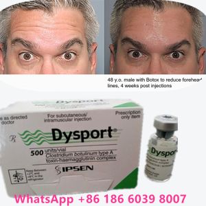 Botulinum Toxin Type A 100 Units Dysport For Removing Use