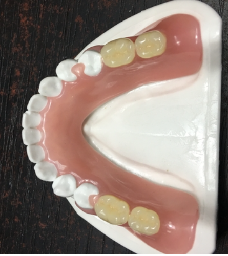 Pink Removable Partial Acrylic Denture Temporary Acrylic Partial Denture
