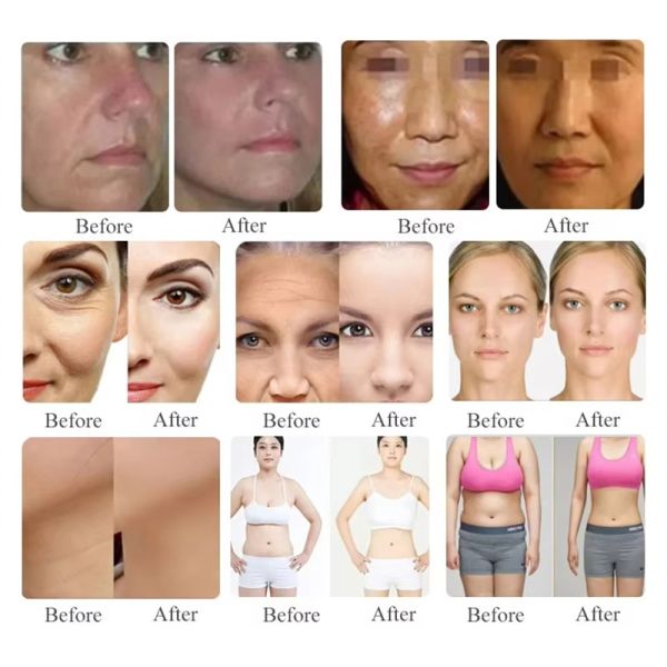 Foldable Wrinkle Removal Micro Focused Ultrasound HIFU 9D Device