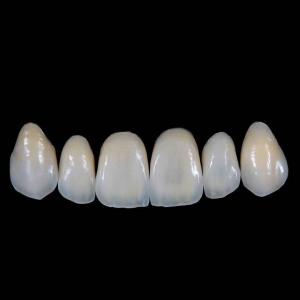 High Translucency Emax Porcelain Veneers Crown with Better Materials by Ivoclar